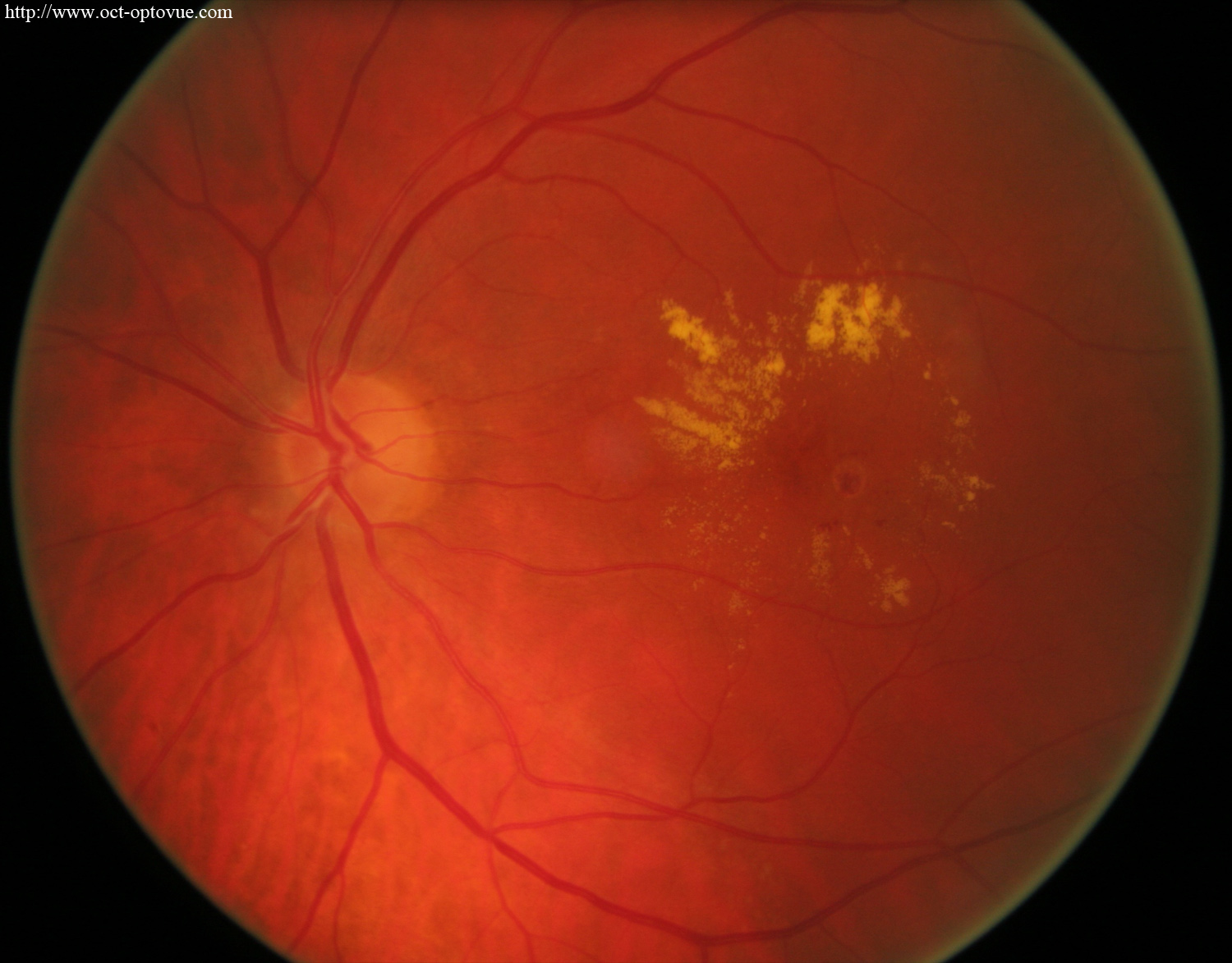 retinal macroaneurysm 