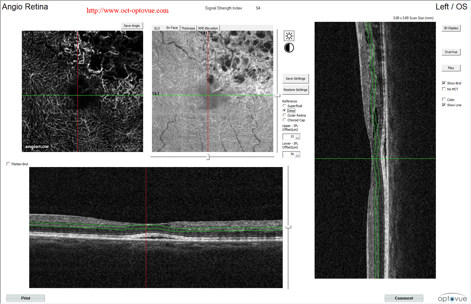 brvo oct-angiography optovue rtvue muratet