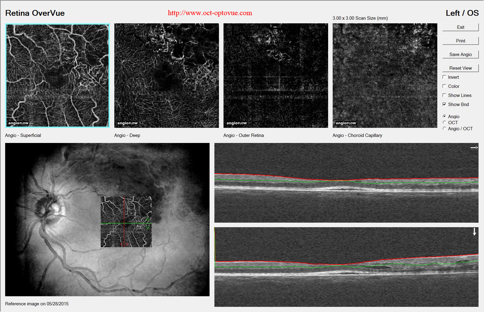 brvo oct-angiography optovue rtvue