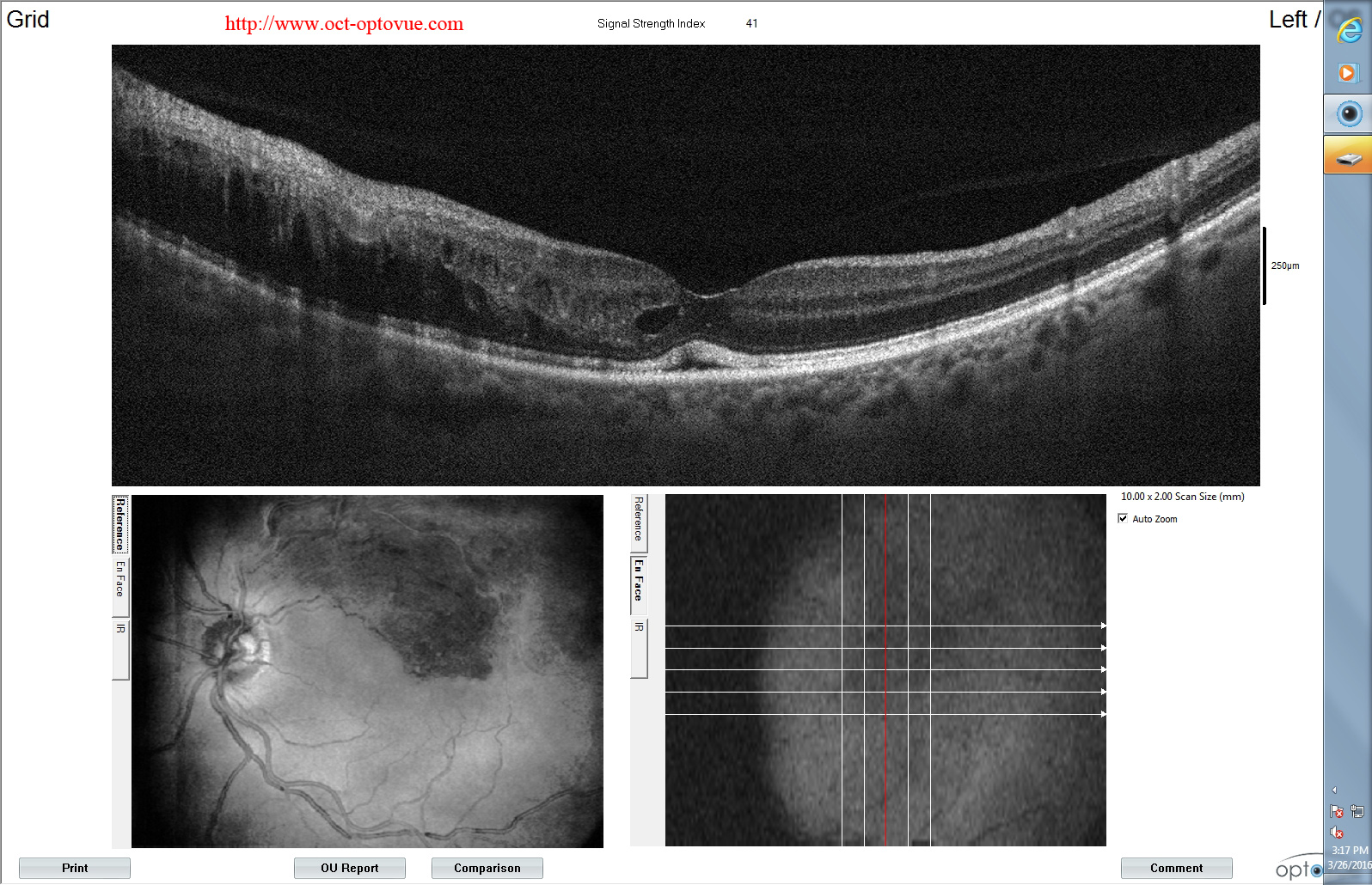 brvo oct retina optovue