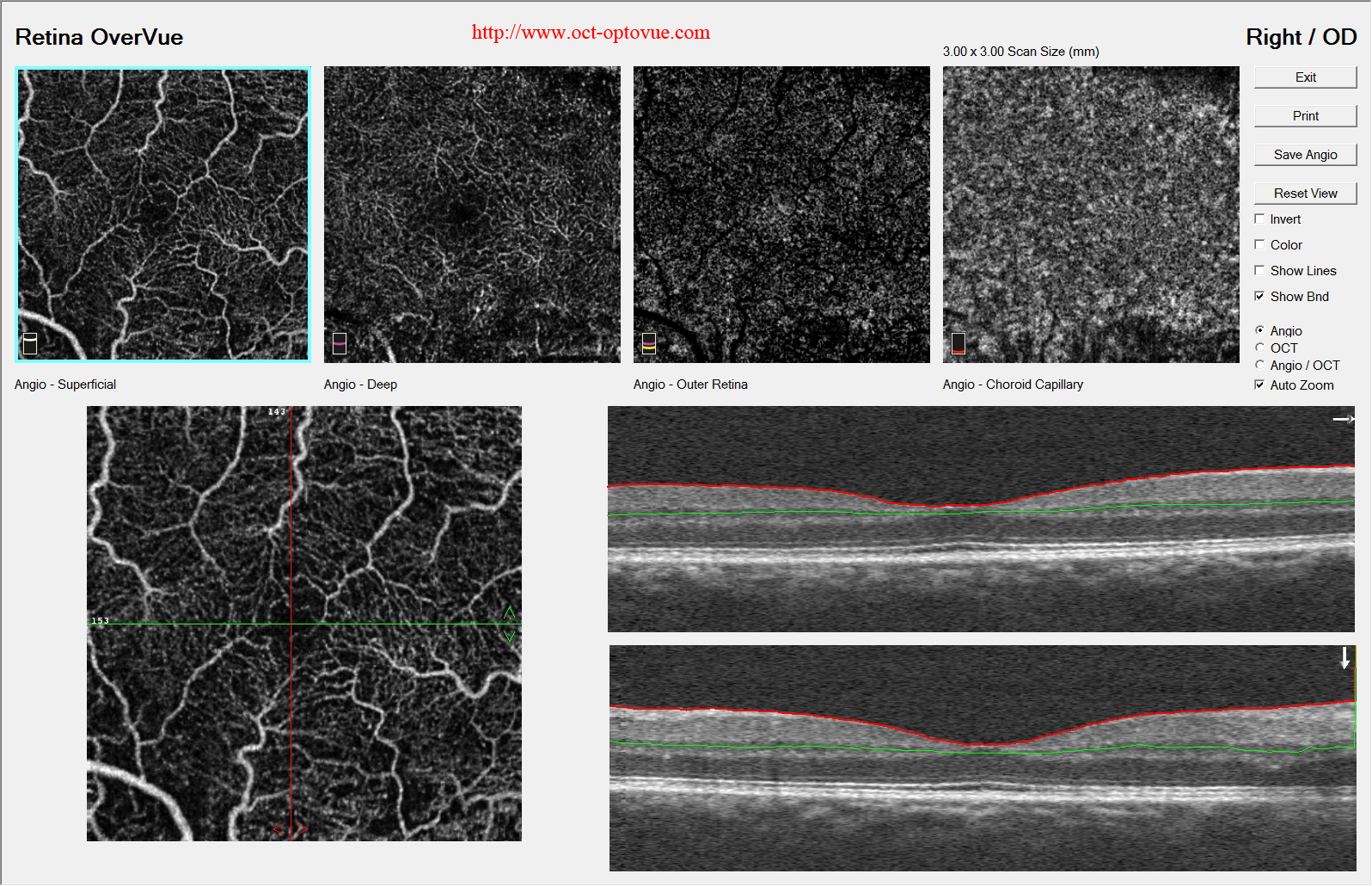 hypertensive retinopathy oct-angiography