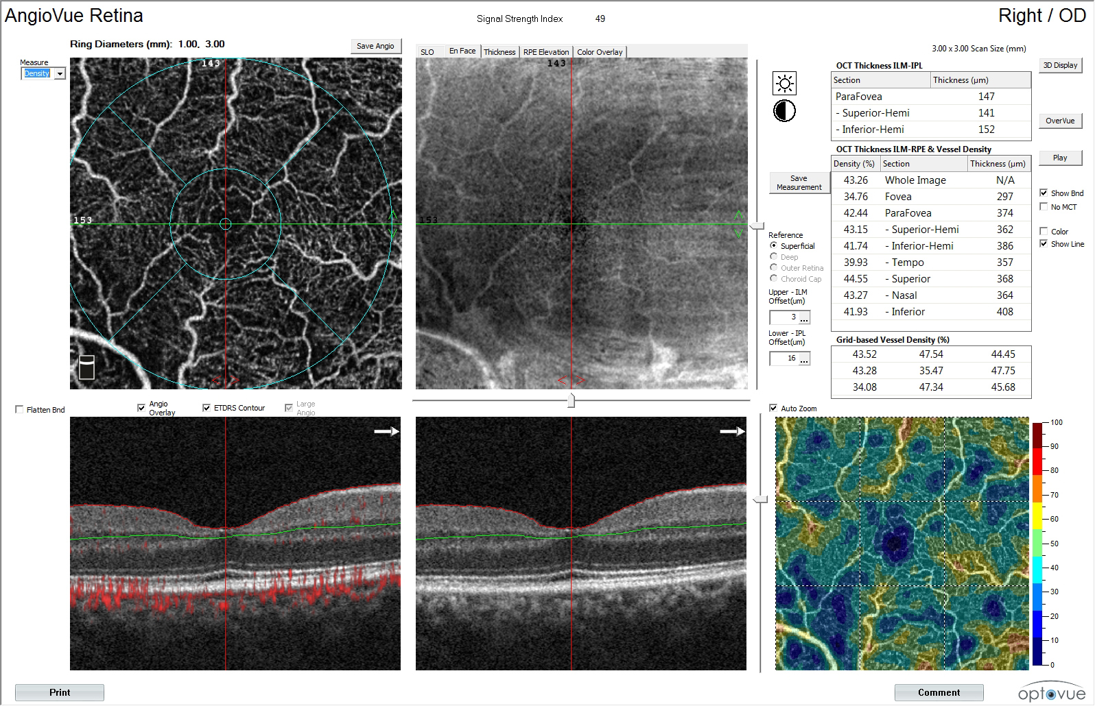 hypertensive retinopathy oct-angiography