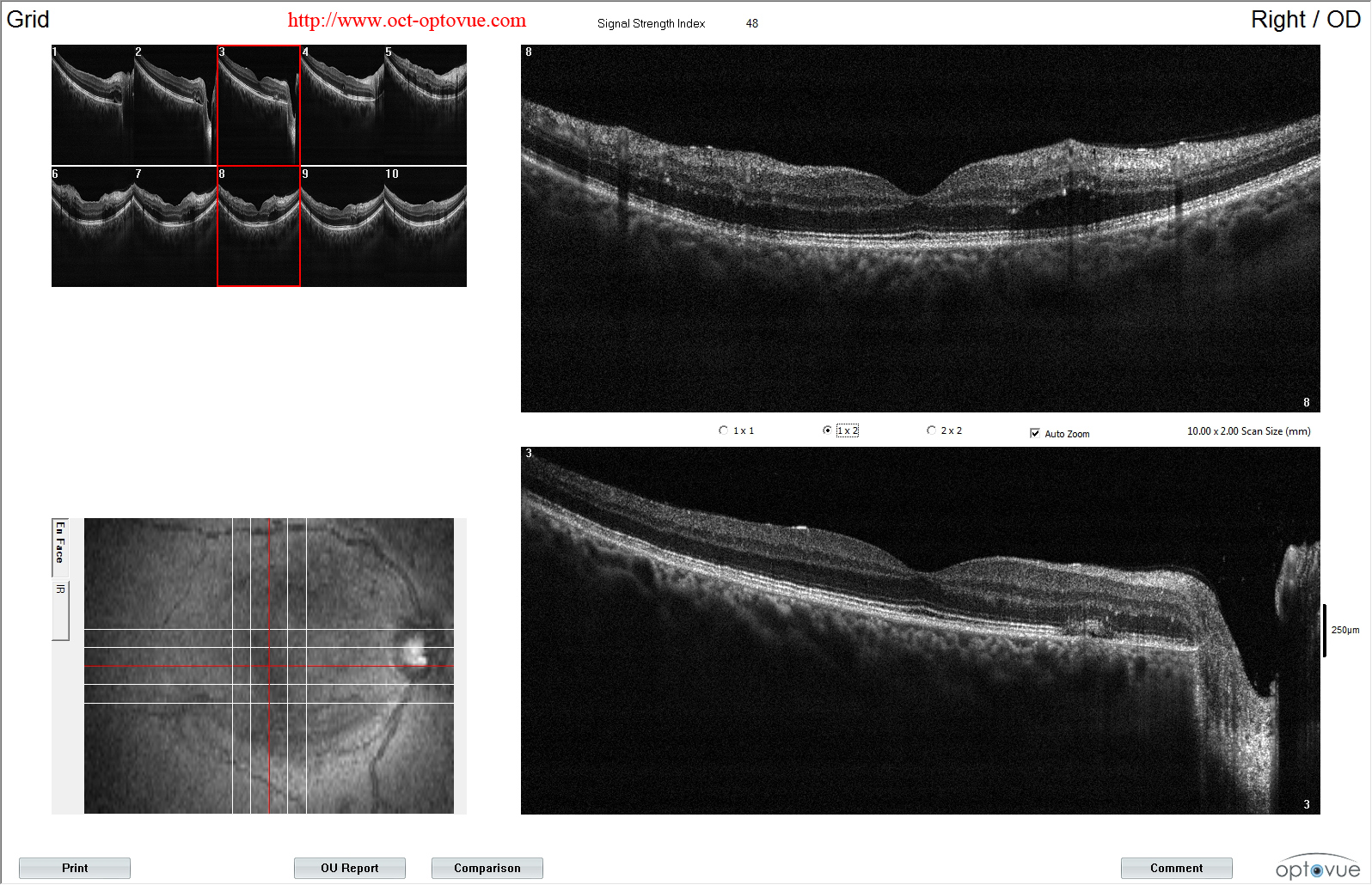 hypertensive retinopathy oct