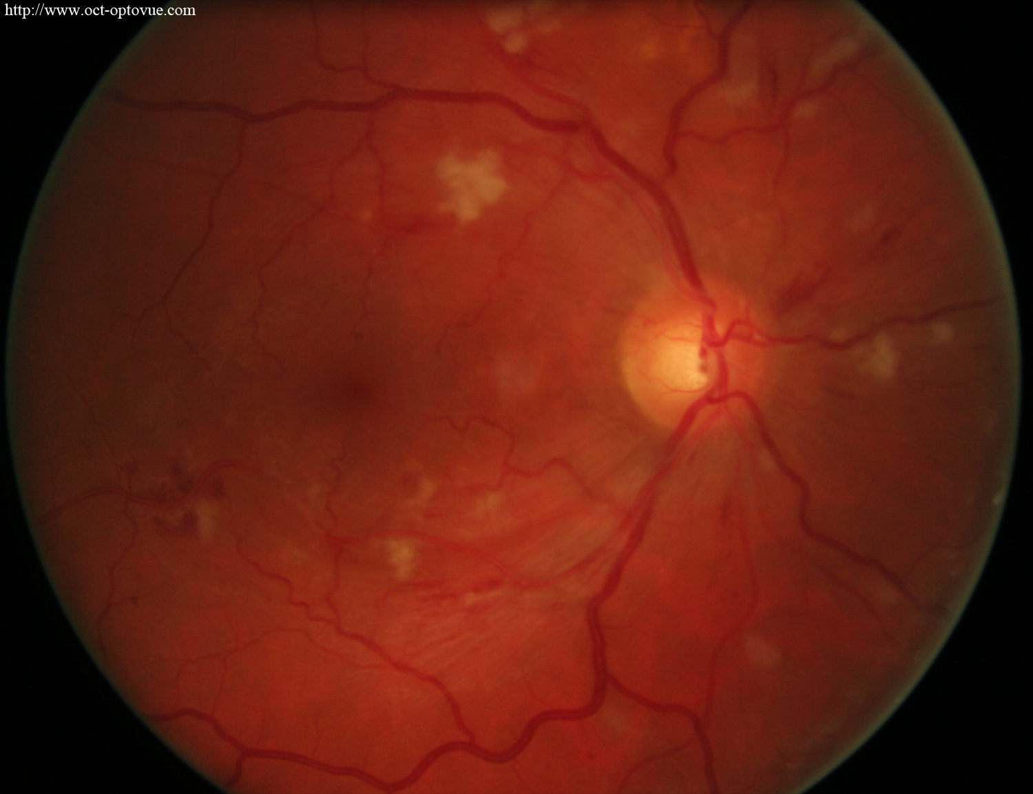 hypertensive retinopathy rétinopathie