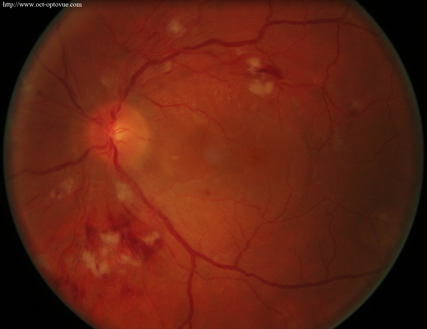hypertensive retinopathy left