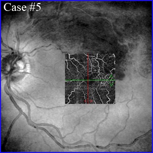 brvo-angiography oct