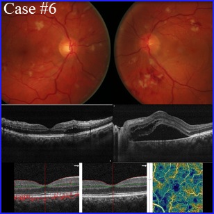 hypertensive-ret304