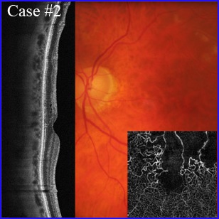 ischemic-angio-oct 