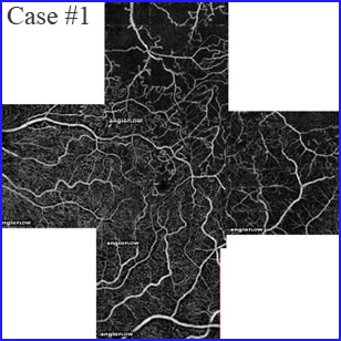 panoramic oct angiography ovcr crvo