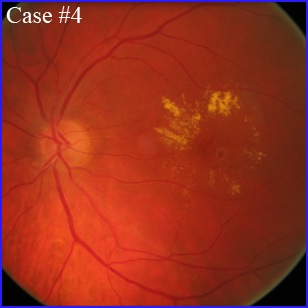 retinal macroaneurysm