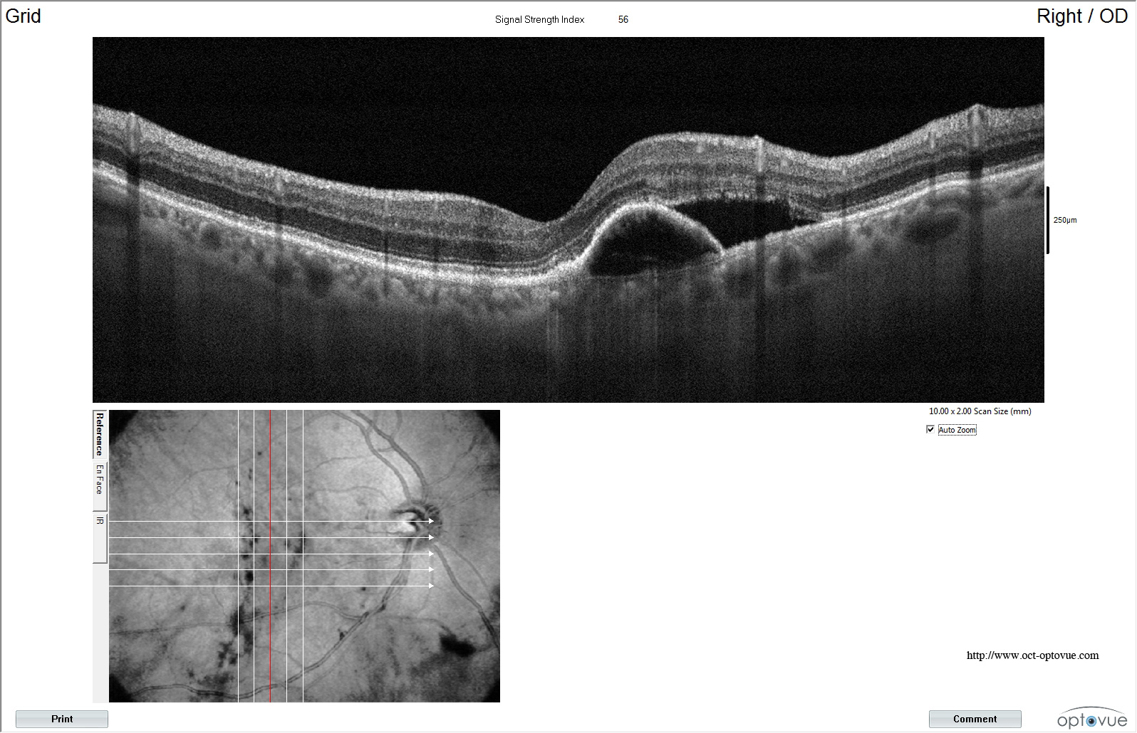 dmla xr avanti oct optovue armd