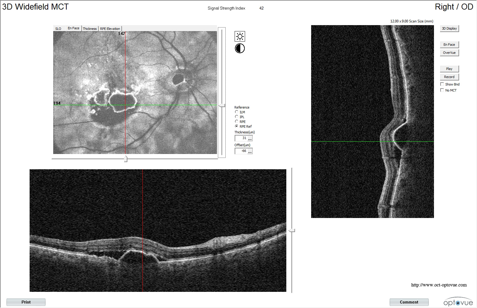 dmla oct optovue xr avanti néovaisseaux