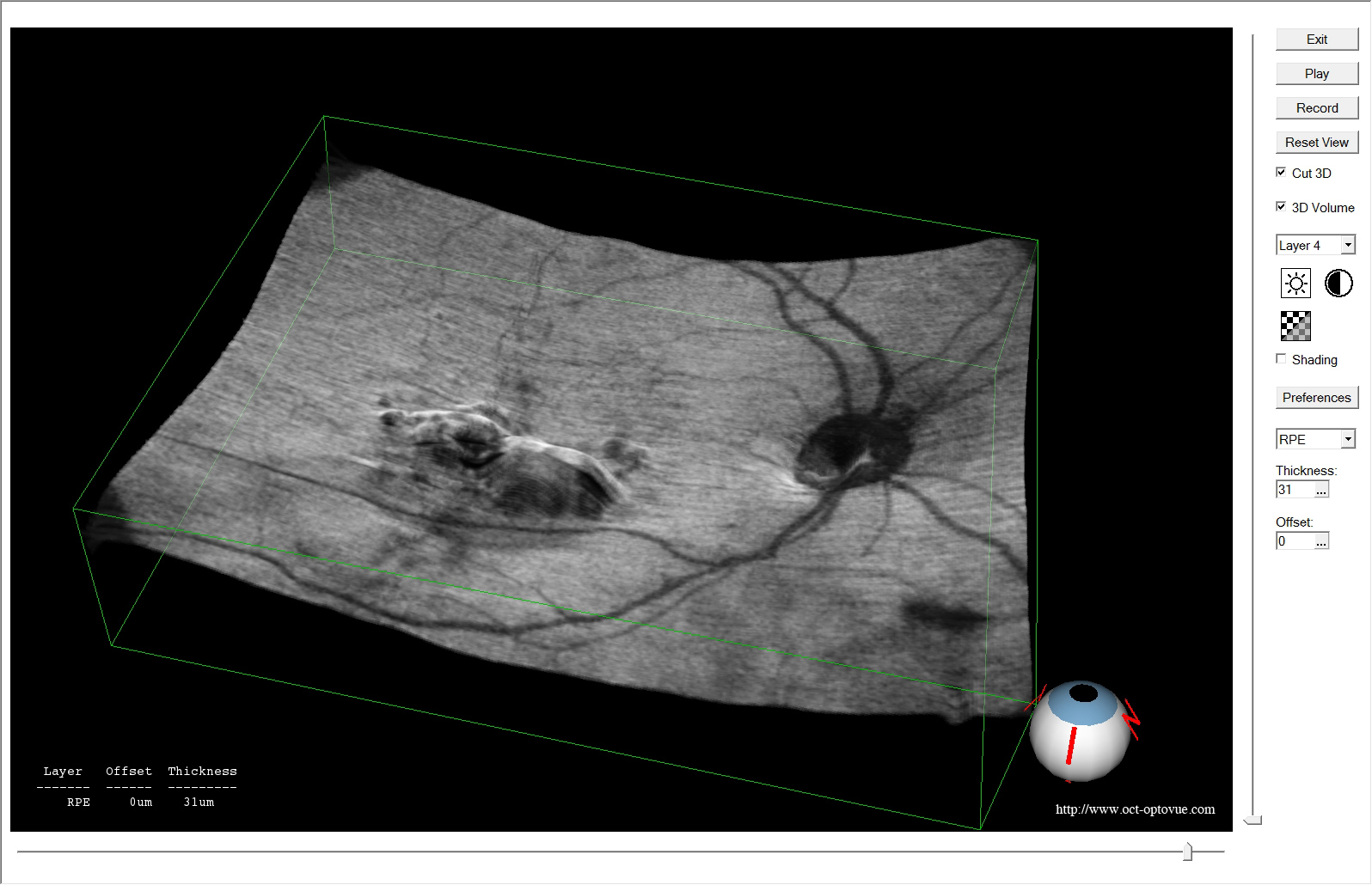 dmla oct optovue xr avanti 3D