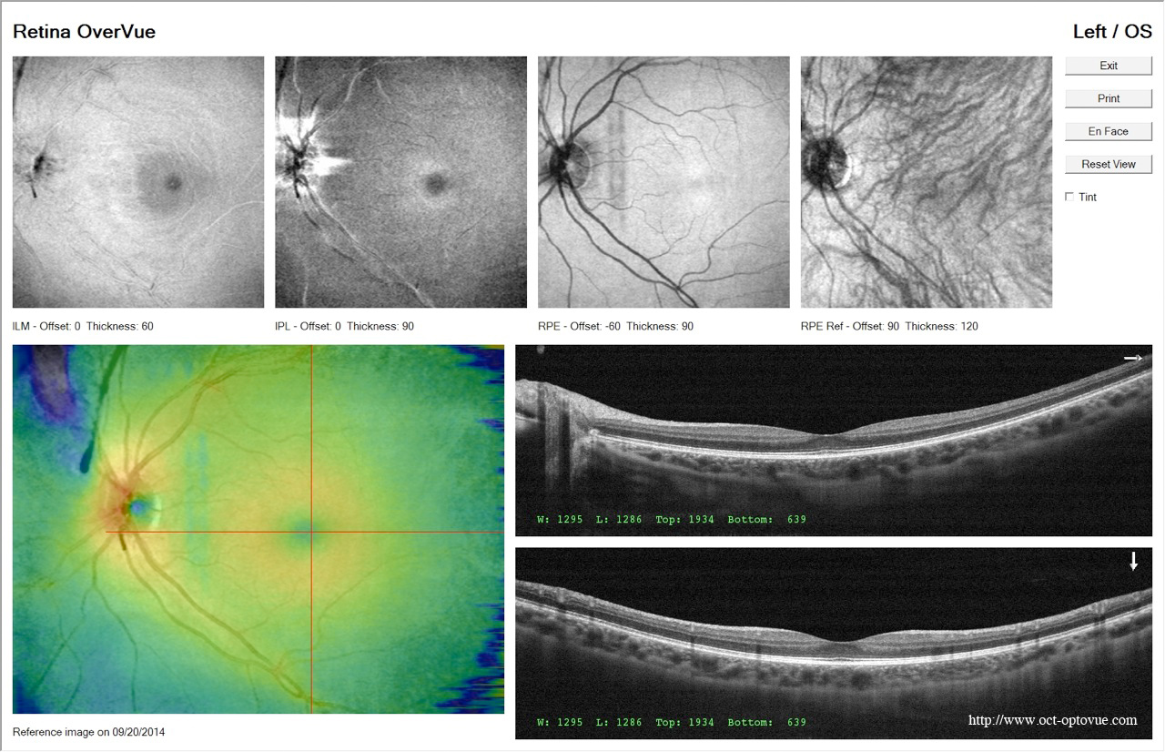 oct avanti retina overvue retine