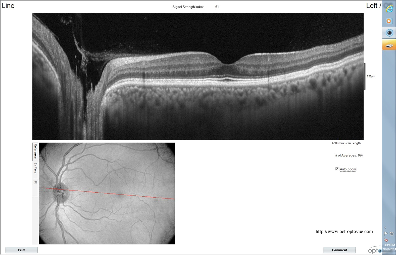 oct optovue avanti retina line xr