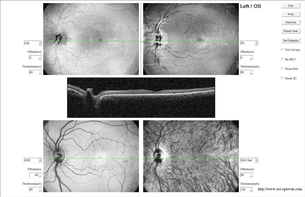 oct-optovue enface avanti en face retina retine
