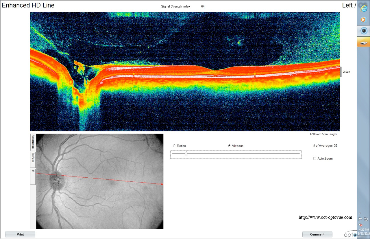 oct optovue enhanced hdline vitreoux vitree