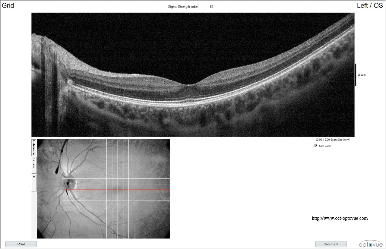 oct optovue enhanced grid