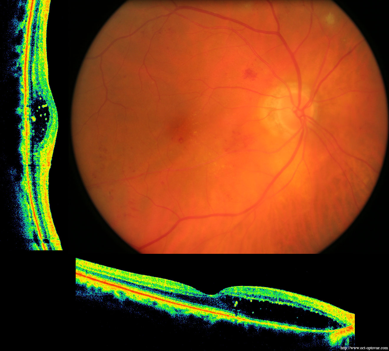 День сетчатки. Микроаневризмы сетчатки. Диабетическая ретинопатия сетчатки глаза. Непролиферативная диабетическая ретинопатия. Диабетическая ретинопатия окт.