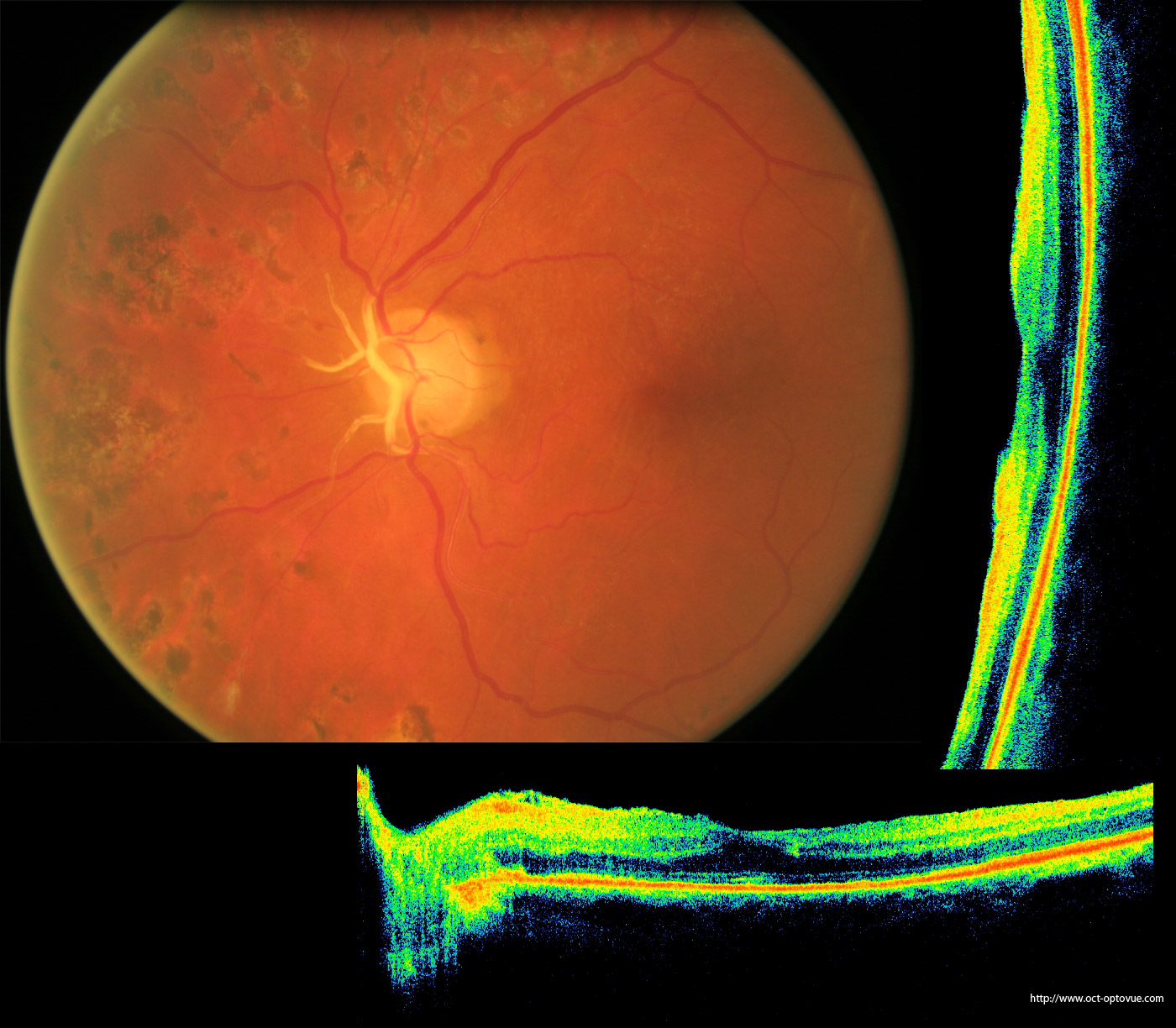 Изображение пропадает если расположено впереди сетчатки. Оптическая когерентная томография при диабетической ретинопатии. ETDRS диабетическая ретинопатия. Микроаневризмы сетчатки. Диабетическая ретинопатия патанатомия.