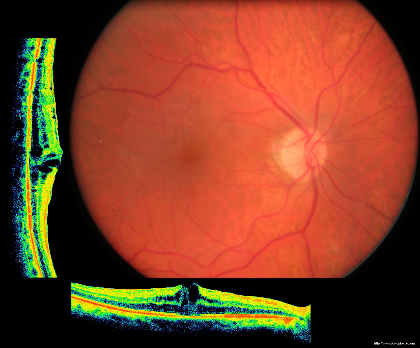 Макулопатия глаза. Периметрия отслойка сетчатки. Отслойка сетчатки глазное дно. Отслойка нейроэпителия сетчатки. Экссудативная макулопатия.