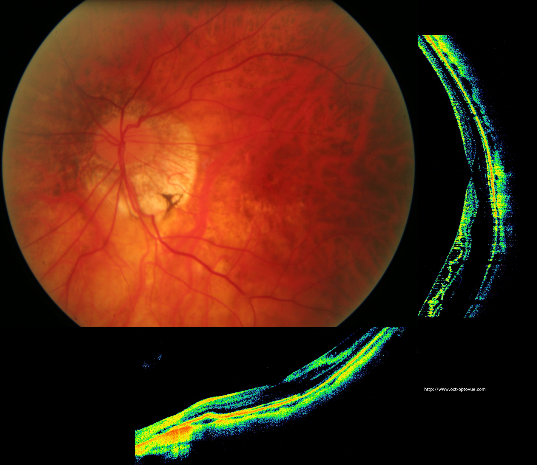 Прижигание сетчатки. Буллезный ретиношизис. Артифакия, ретиношизис. Макулярный разрыв сетчатки.