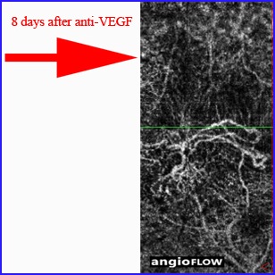 angio-oct antivegf lucentis eyelea