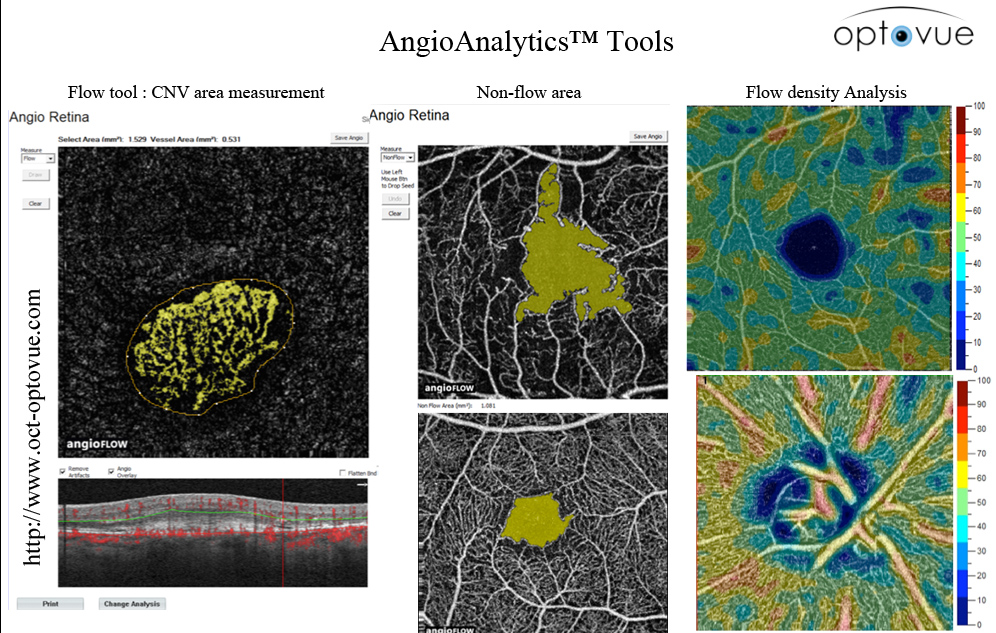 angioanalytics blood-flow area measurement