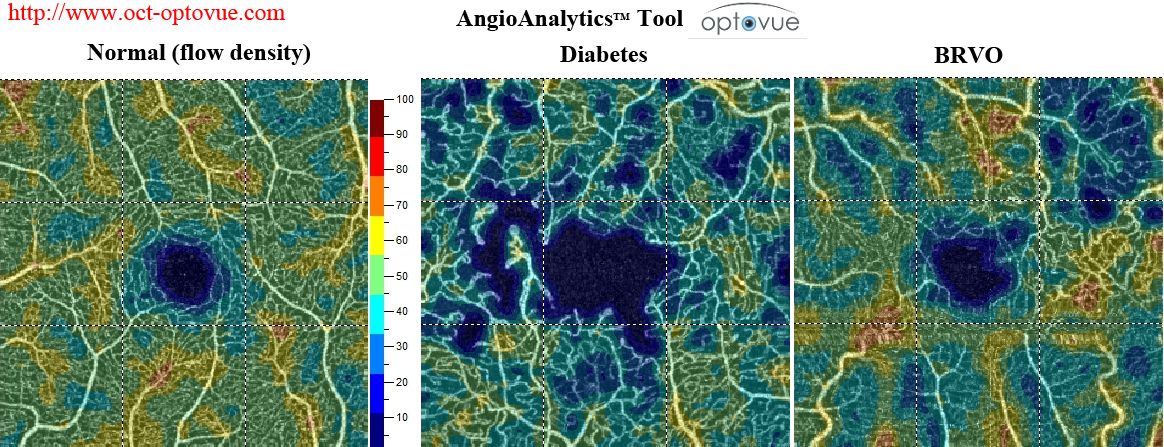 angioanalytics optovue flow density no flow