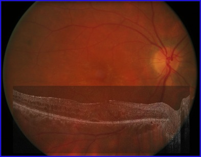 birdshot retinopathy oct angiography