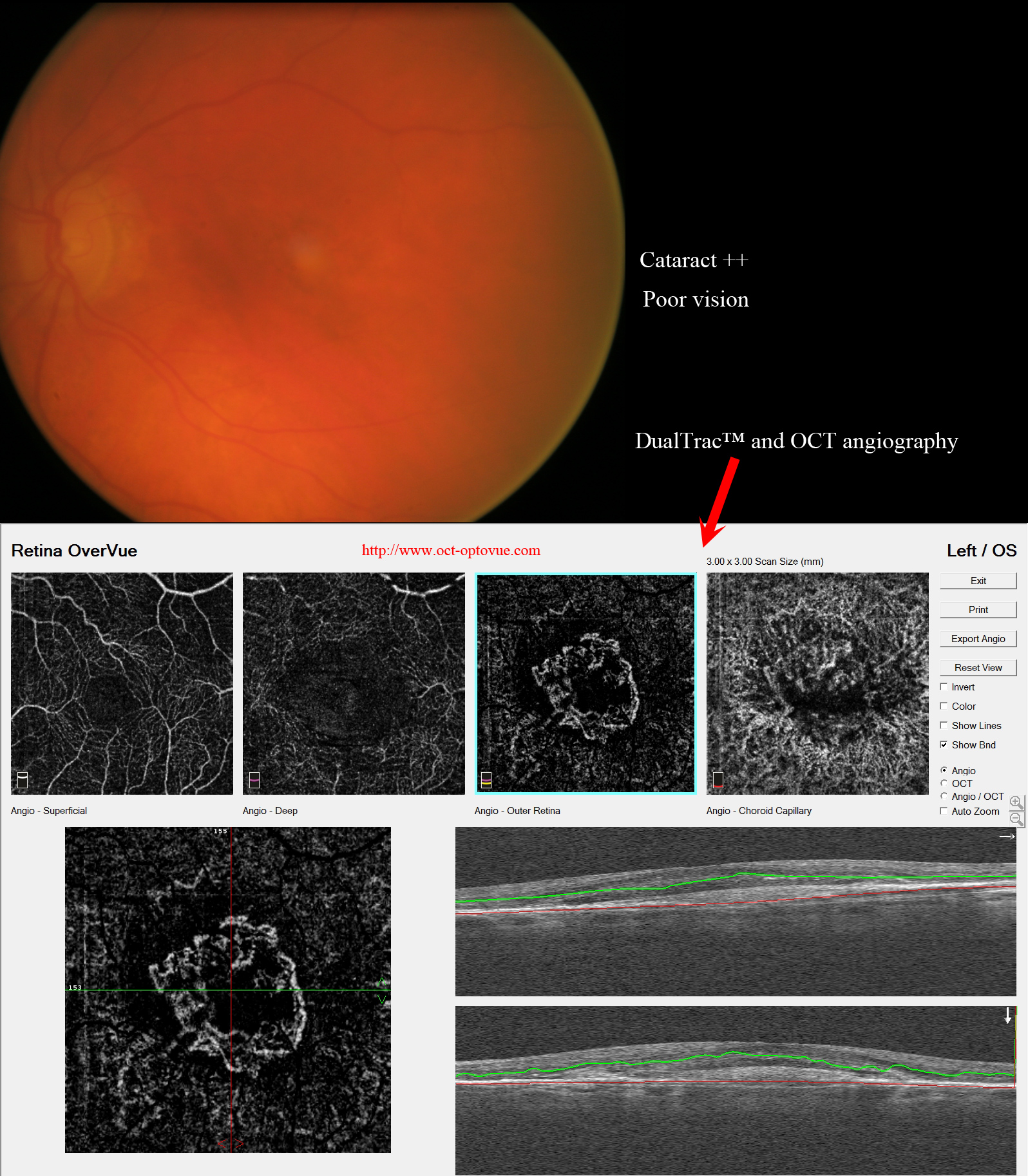 cataract-dualtrac motion correction optovue cnv