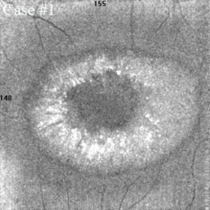 chloroquine intoxication maculopathy