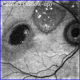 chronic-csr Chronic central serous chorioretinopathy (CCSC)