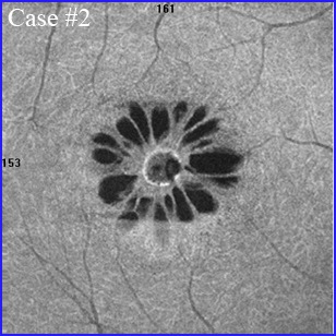 macular-hole-angiography