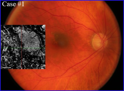 nevus-oct-angiography-304