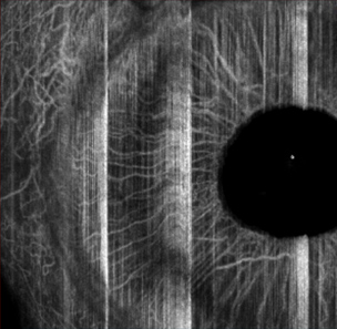 oct-angiography iris cornea