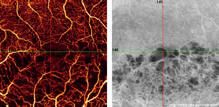 oct angiography optovue xr avanti