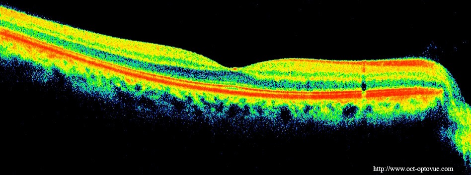 oct eye oeil retina retine optovue rtvue-100 optical coherence tomography