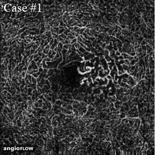 macular telangiectasia oct angiography