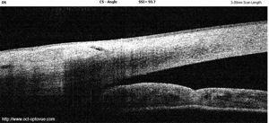 angle irido-corneen oct normal optovue