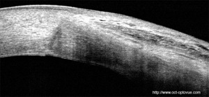 glaucome opéré glaucoma oct