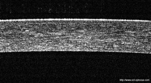 oct lasik optovue cornea cornée