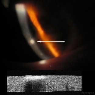 oct cornea abscess abces cornee lentille souple