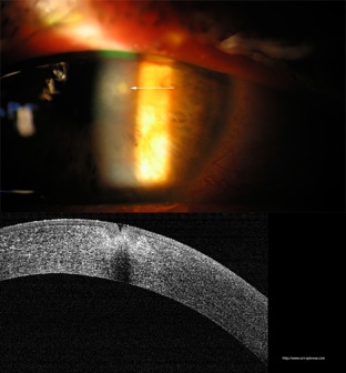 corneal ulcer ulcère cornéen traumatique oct