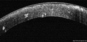 groenouw cornee cornea oct groenouv gronouw groenouew cornea