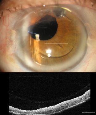 oct implant cristallinien segment antérieur anterior segment