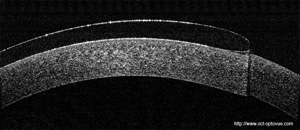 lentille dure oct flex lens optovue