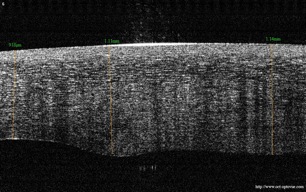 oedema retinal retine oedeme oct optovue