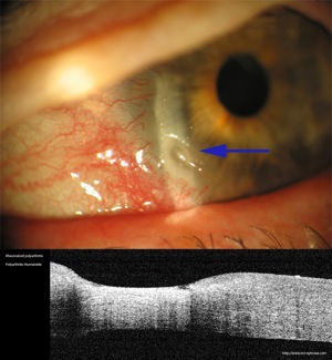 oct rheumatoid polyarthritis polyarthrite rhumatoide