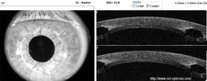 anneaux cornéens rings oct optovue